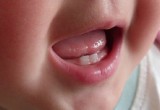 Răng sữa mọc bất thường, có cần nắn chỉnh?