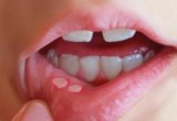 Cách chữa viêm loét miệng đơn giản, an toàn tại nhà